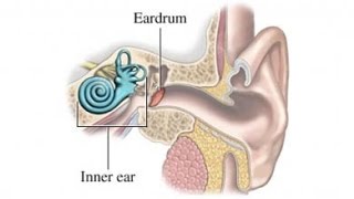 Meniere Disease [upl. by Sirraf]