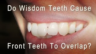 Do Wisdom Teeth Cause Front Teeth To Overlap and Get Crowded [upl. by Rosenfeld]