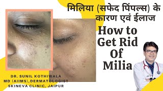 Milia को कैसे ठीक करे  Milia Removal Treatment in Hindi  Milia Treatment In Jaipur  Dermatologist [upl. by Ahsel]