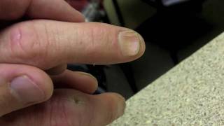 Finger Nail Deformity  Mild Spoon Nails [upl. by Howund182]