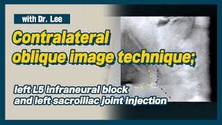 Learn contralateral oblique image Carm anatomy SIJ and infraneural transforaminal injection [upl. by Eddra]