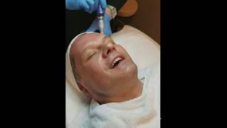 Micro Needling Treatment for Skin Wrinkles [upl. by Enaasiali]