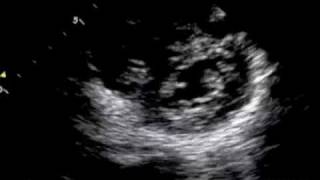 Pulmonary Embolus Arrival [upl. by Airbma]