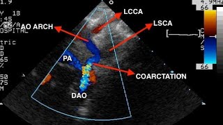 Aortic Coarctation Echocardiography Findings [upl. by Beeck]