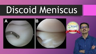 Discoid Meniscus  All You want to know Discoid Lateral Meniscus [upl. by Kingston]