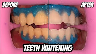 Teeth Whitening Process  BEFORE and AFTER  BLEACHING [upl. by Essiralc]