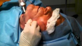 Liposuction of the Lower Face and Jowls [upl. by Enohpesrep]