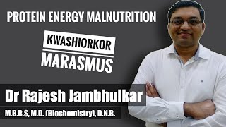 PROTEIN ENERGY MALNUTRITION PEM Kwashiorkor and Marasmus [upl. by Neela]