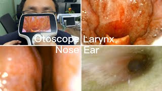 ENT Endoscopy Ear Nose Throat Examination  Using BESDATA Handheld Portable Otoscope [upl. by Tnek120]