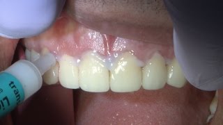 Case of the week Veneers Two Ways Obsidian® amp Solid Gold [upl. by Bryn]