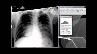 Image Critique Portable Chest Xray [upl. by Akenom583]