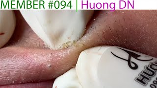 Acne Treatment Huong Da Nang 094  Member  Huong [upl. by Nuawaj423]