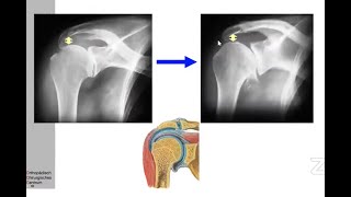 Principles of Anatomic Vs Reverse Shoulder Arthroplasty [upl. by Ruthven133]