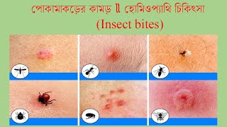 পোকার কামড়ে কি কি করণীয় ও কি ওষুধ প্রয়োজন Insect bite Homeopathic treatment and medicine [upl. by Cerveny]