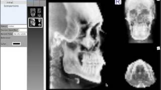 Quick Ceph Studio  Extracting Lateral Frontal SMV Views from CT Scans for Tracing [upl. by Gregorio164]