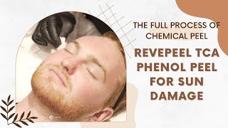 The FULL Process of Chemical Peel  RevePeel TCA PHENOL PEEL FOR SUN DAMAGE  Dr Jason Emer [upl. by Lalage736]