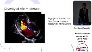 Athletes with bi cuspid aortic valve Keep pushing  Prof Michael Papadakis [upl. by Lemay]