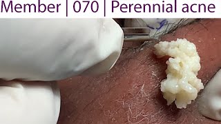 Acne Treatment Huong Da Nang 070  Perennial acne [upl. by Aned]