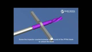 PFNA  Surgical Technique clavo endointromdular [upl. by Palestine642]