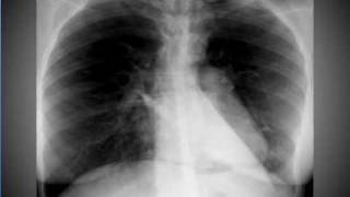 Chest xray Pneumomediastinum [upl. by Nacnud100]