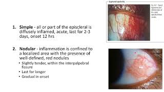 EPISCLERITIS AND SCLERITIS [upl. by Matias]