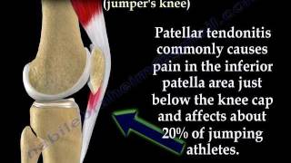 Patellar Tendonitis Jumpers Knee  Everything You Need To Know  Dr Nabil Ebraheim [upl. by Nivac855]