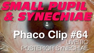 Phaco Clip 64  Uveitic Posterior Synechiae [upl. by Cinimod]