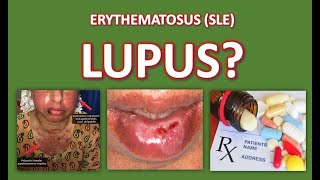 What is Lupus [upl. by Ennaxor]