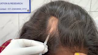 Alopecia areata  Injection technique for Triamcinolone acetonide  10 mgmL Dr Bhawuk Dhir [upl. by Ahsercel]