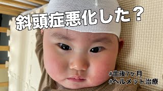 【斜頭症】2回目の頭の形測定に行ってきました生後7か月 あかちゃん 斜頭症 [upl. by Nygem]