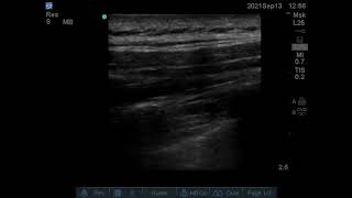 ultrasound guided paravertebral block  screening block [upl. by Aneer]