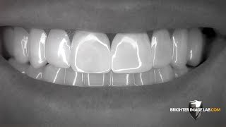 Brighter Image Lab BilVeneers™ The Future of No Dentist Dental Veneers [upl. by Sldney]