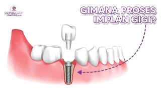 ANIMASI PROSES IMPLAN GIGI [upl. by Tnomad553]