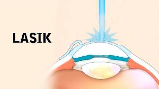 LASIK Surgery and its Risks [upl. by Dorcia]