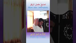 تصنيعُ مفصلِ المرفقِ ذاتيَّاً Elbow Auto Arthroplasty [upl. by Eserrehs204]