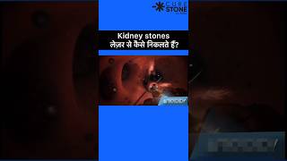 Kidney stones Treatment  RIRS  Laser kidney stone treatment shorts [upl. by Valenka]