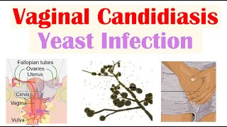 Vaginal Candidiasis “Yeast Infection” Causes Risk Factors Signs amp Symptoms Diagnosis Treatment [upl. by Aiekam99]