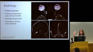 quotIntracranial Hypertension Pseudotumor Cerebri amp Associated Headachequot  Julie Roth MD [upl. by Enimassej]