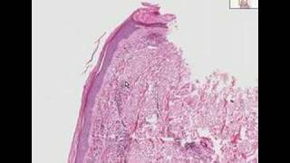 Histopathology SkinLeukocytoclastic vasculitis [upl. by Akemit]