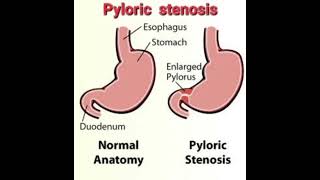 Pyloric stenosis Fluid calculation mrcpch Recall Communication [upl. by Eemyaj498]