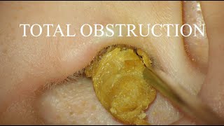 TOTAL OBSTRUCTION  EAR WAX REMOVAL  4KHD [upl. by Milks]