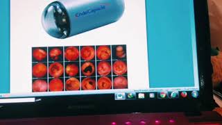 capsule endoscopy gastric analysis التنظير بالكبسولهتحليل حمض المعده [upl. by Sirromed]