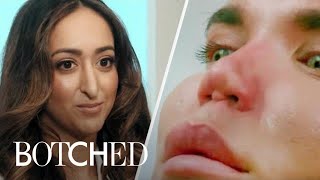 The Most Intense Nose Surgeries From Botched  E [upl. by Garibald897]