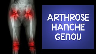 Arthrose au genou et à la hanche  des exercices étonnants [upl. by Aspasia]