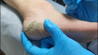 Pedicure  Wow Look at cracked heels Dead skin removal and Cracked heels treatment [upl. by Aynekat]