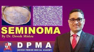 SEMINOMA Pathology by Dr Devesh Mishra [upl. by Ludovika307]