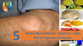 5 Home Remedies for Lipomas  Get Rid of Lipomas at Home [upl. by Kasey]