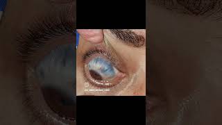 ophthalmologists retinal eyedisease anterior staphyloma secondary to scleromalacia [upl. by Arymahs]