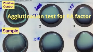 Agglutination test for detecting Rheumatoid factor [upl. by Chilt]