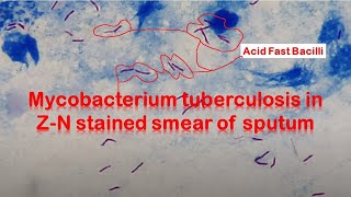 Mycobacterium tuberculosis in ZiehlNeelsen stained smear of Sputum [upl. by Ortrud407]